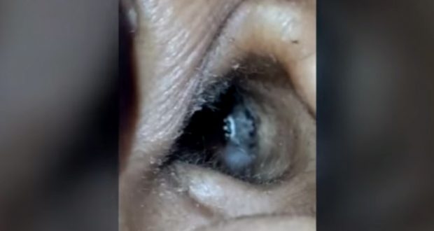 देखें विडियो: महिला के कान से जो निकला वह हैरान करने वाला था...