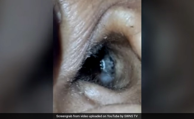 देखें विडियो: महिला के कान से जो निकला वह हैरान करने वाला था...