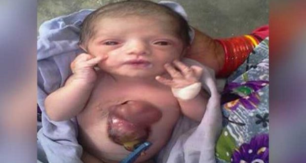 देखे फोटो: जन्म लेते ही सीने के बाहर धड़कता है इस बच्ची का दिल, डॉक्टर भी है हैरान...